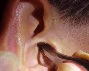 500万像素高清成像，隐秘耳道一览无遗，挖耳朵也能科技感爆棚