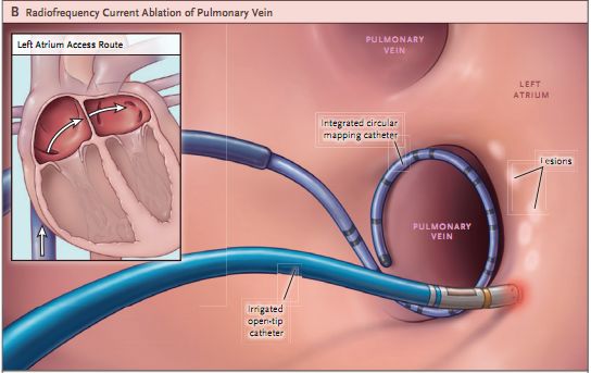 一文盘点：治疗室速的8种方法