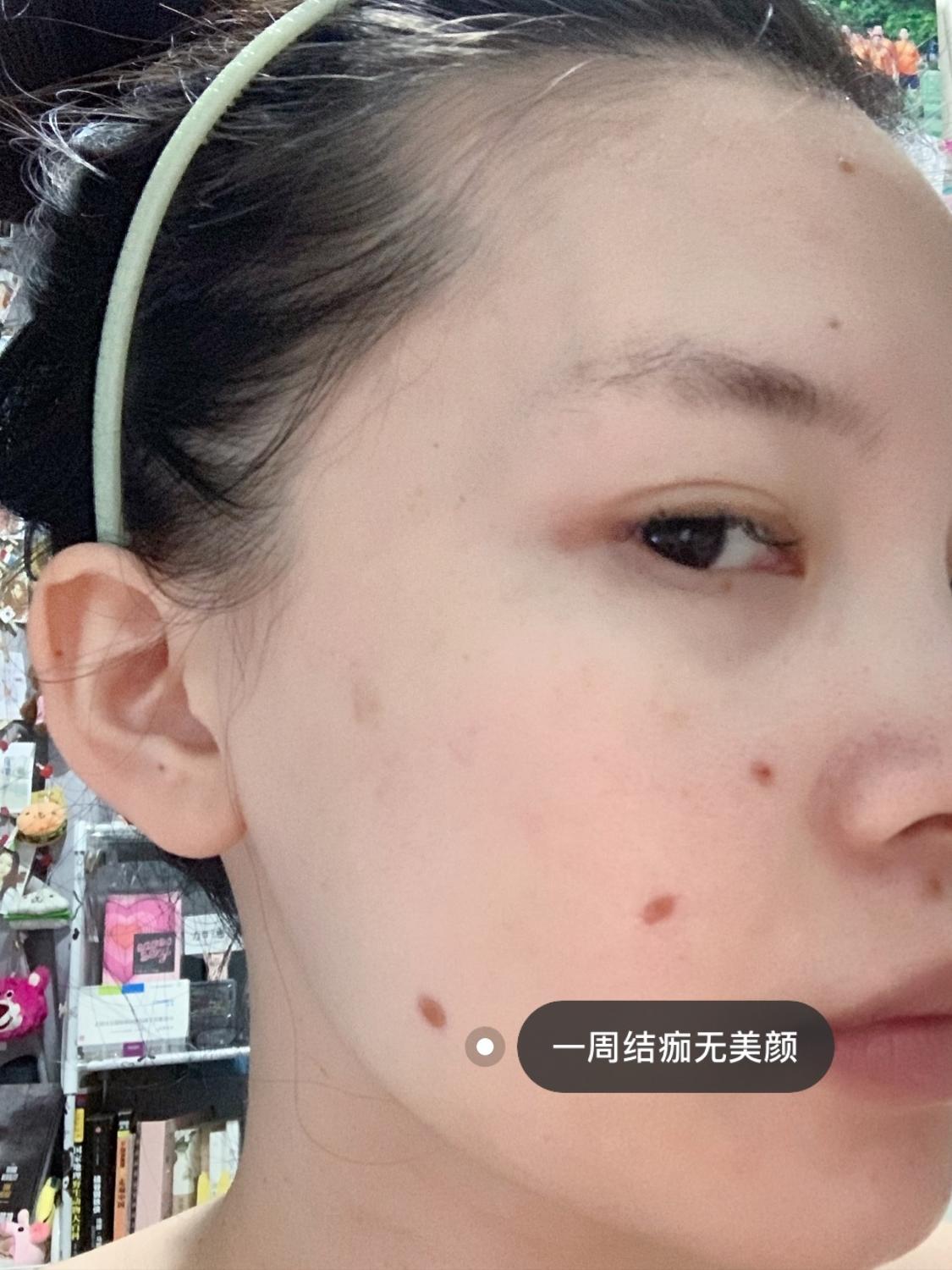 激光点痣后要忌嘴多久,激光点痣前需要消毒吗