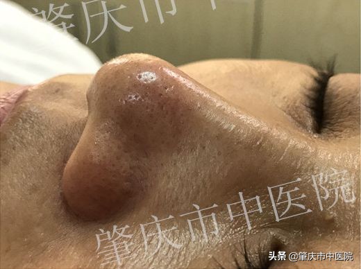 春夏之交，黑头来袭？这才是正确祛除黑头的打开方式！