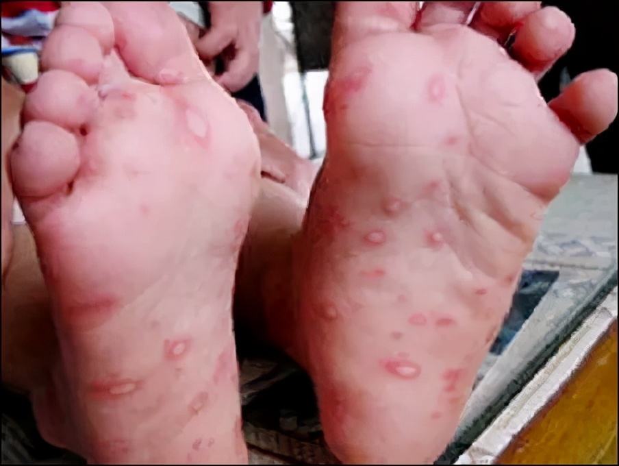 痒痒痒！身上出现这种小水疱，千万别戳破