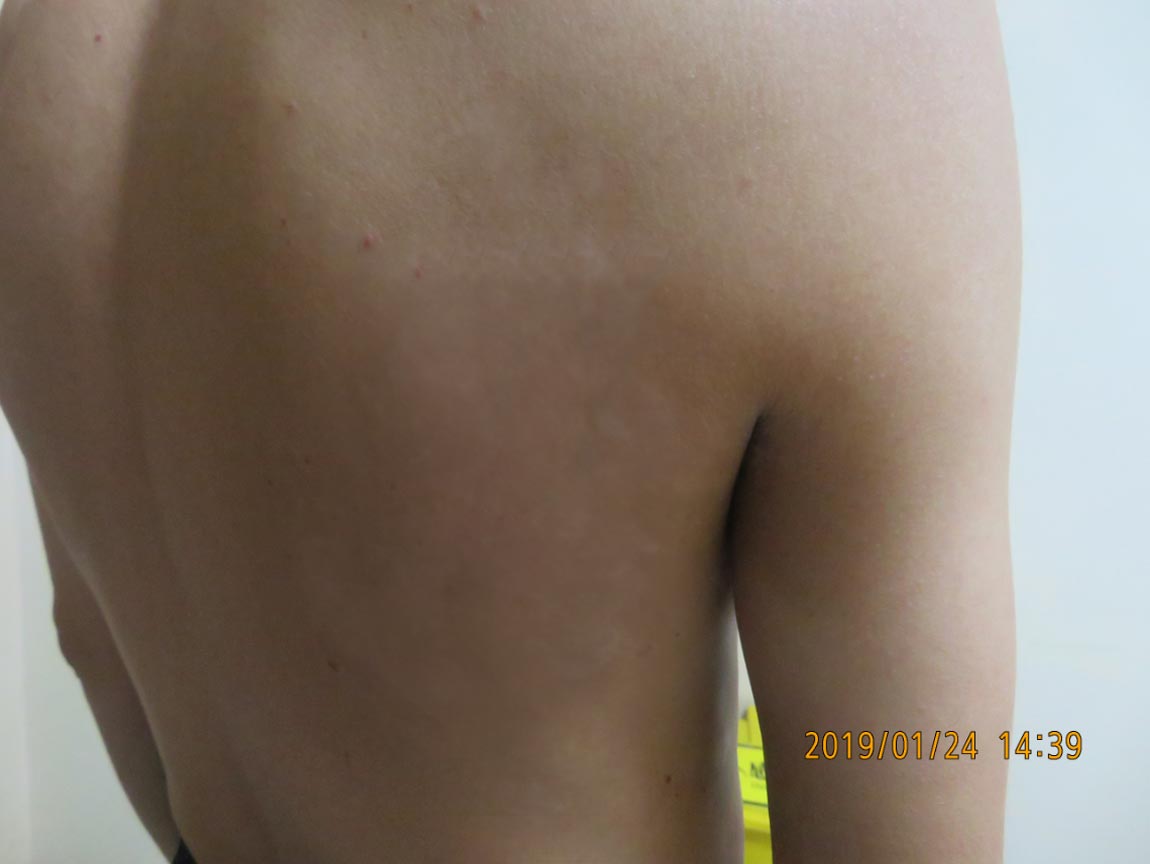 白癜风uvb光疗效果,uvb光疗仪治疗白癜风对皮肤的危害