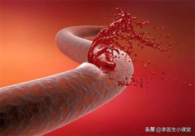 高血压引起脑出血急救方法,高血压脑出血晕倒一小时急救