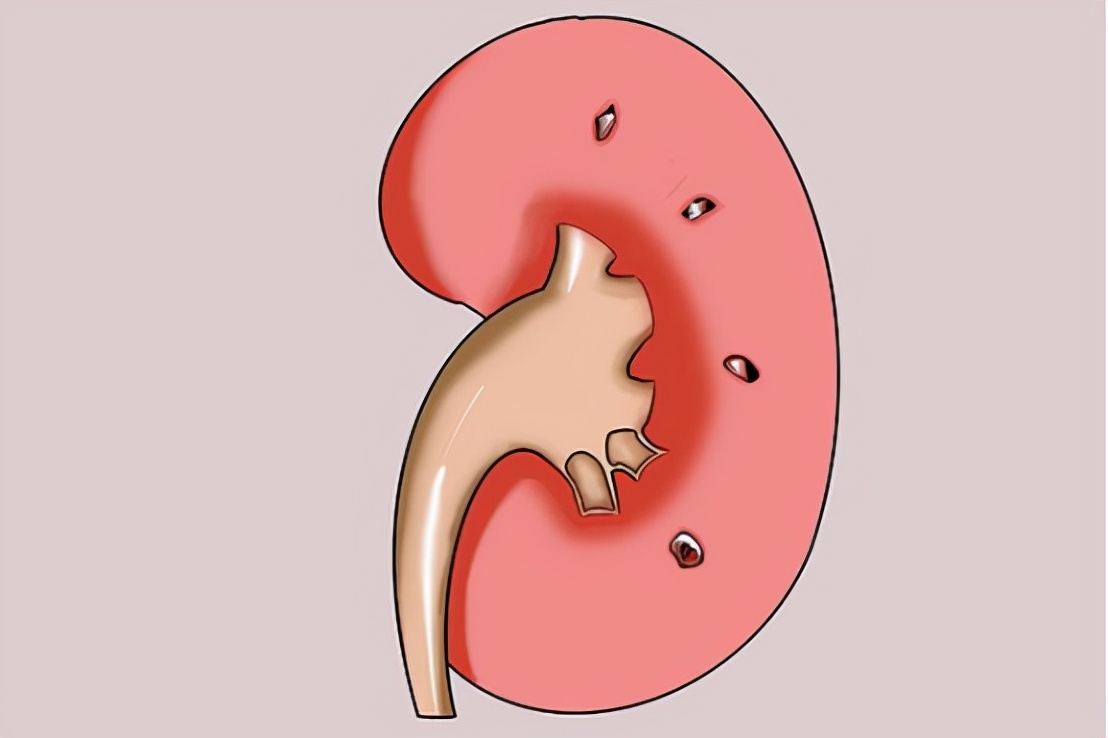 36岁高血压能长期服用降压药吗,突发性高血压需要长期吃降压药吗
