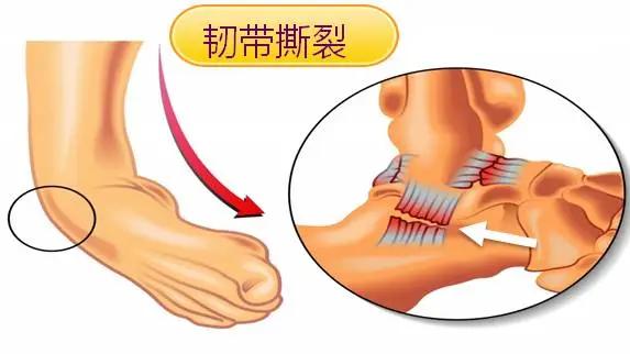 孩子韧带拉伤怎么做康复训练,孩子韧带拉伤怎么办