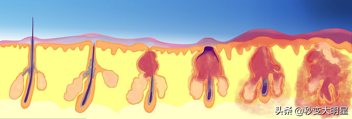 收缩毛孔的7个专家建议,收缩毛孔的最好方法一个月