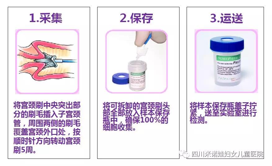 女性恶性肿瘤：宫颈癌，怎么快速筛查？TCT与LCT哪种好？