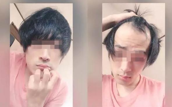 日本人秃头,日本秃头率亚洲第一