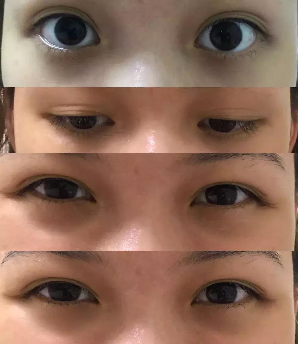 改善眼袋仅980元不开刀让你更出众,消除眼袋细纹大概多少钱