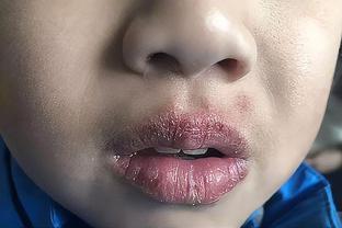 冬季孩子嘴唇起皮、干裂还出血？三招教你正确护理，光喝水没用