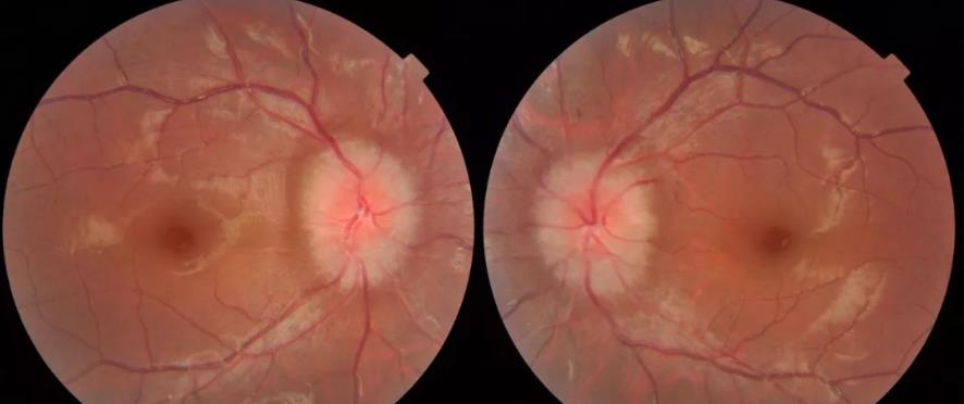 颅高压第一篇:视乳头水肿