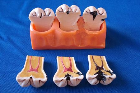 牙齿龋坏补牙能维持多久,牙齿龋坏比较严重补牙效果好吗