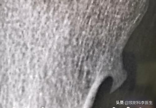 不同性别患者，同因外伤检查相同部位，发现相同位置的同一疾病？