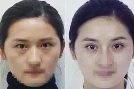 去眼袋15年后有细纹怎么办,祛眼袋之后会不会看着很平