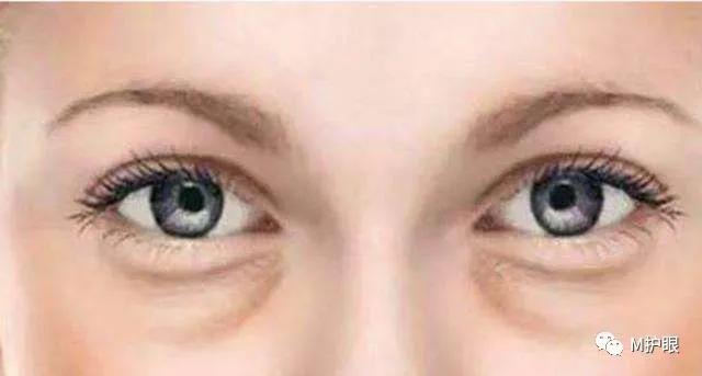 睡觉前喝水，第二天早起眼睛会肿，这是为什么？