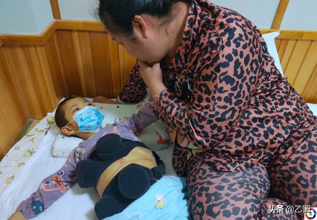 孩子四年经历三次手术,男孩4次开腹手术