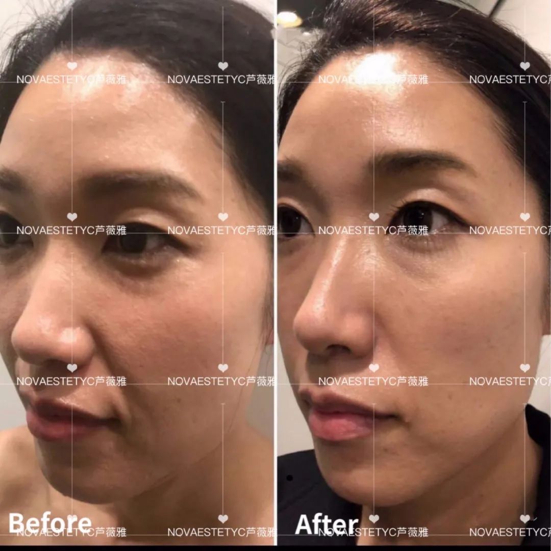 无痛热玛吉多少钱一次,无痛热玛吉效果多久才出来