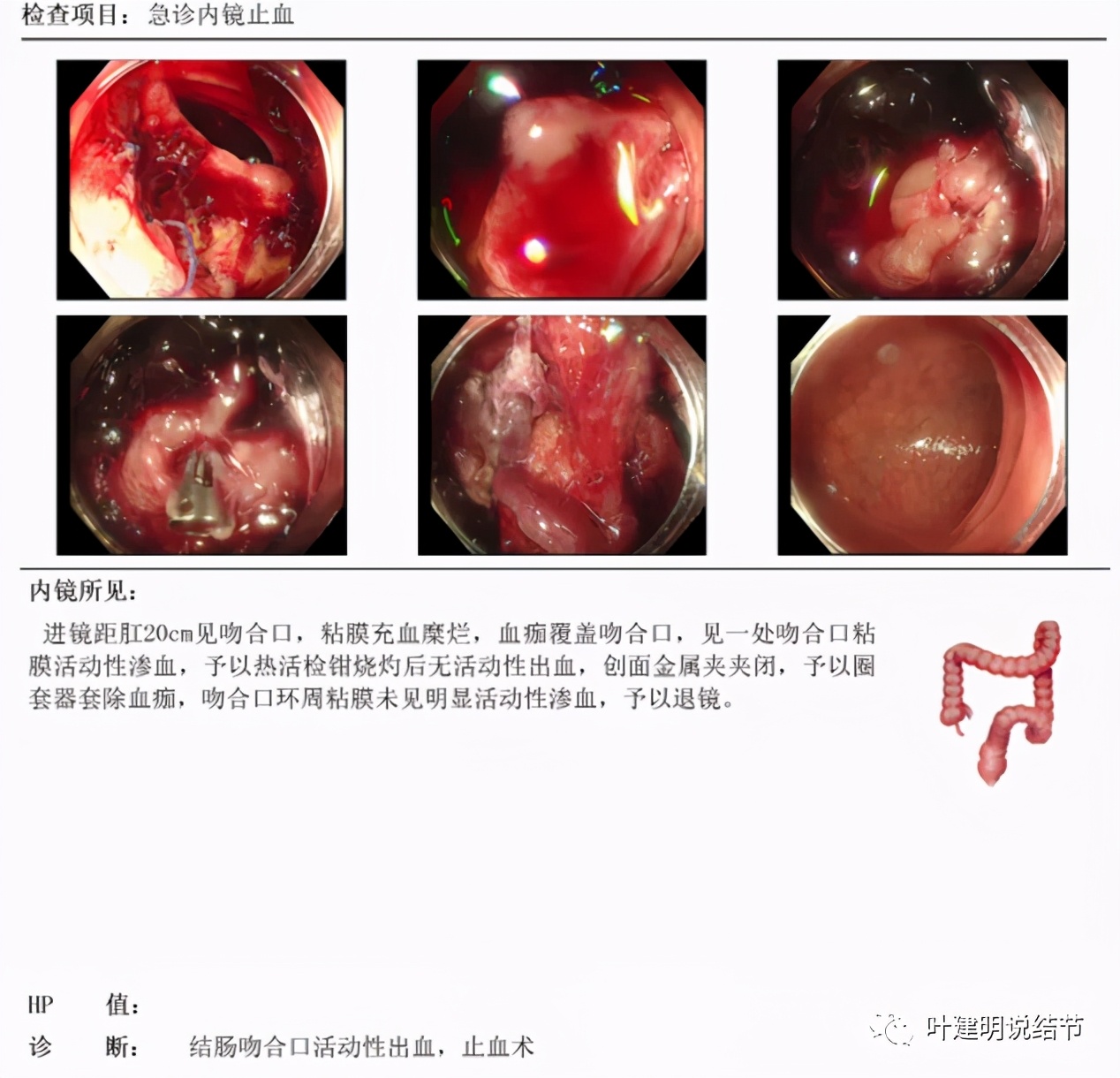 同时患结肠癌和直肠癌怎么办,同时查出了胃癌和肺癌怎么办