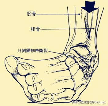 崴脚了怎么办最快最有效的方法,崴脚总是崴一个地方怎么治疗