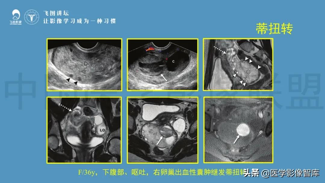 子宫解剖结构输卵管和卵巢位置,子宫附件ct影像学正常解剖表现