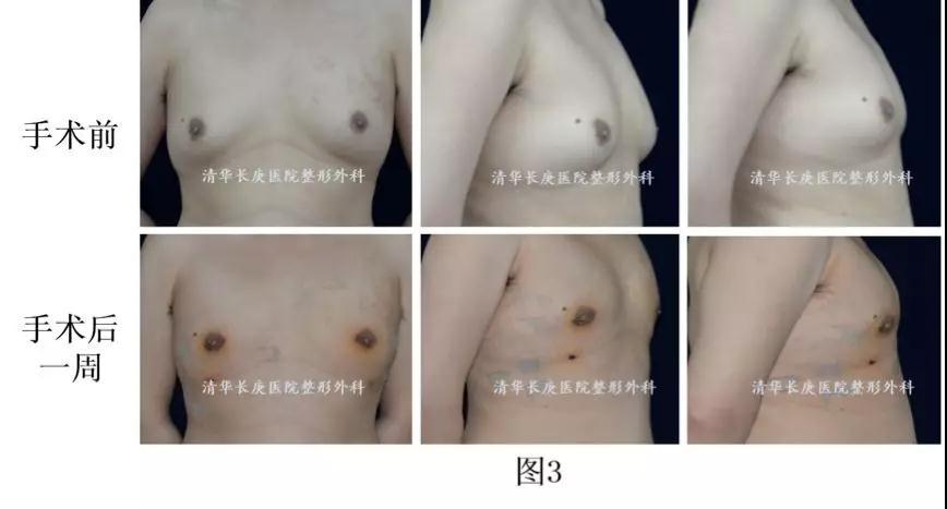 男人的胸肉太大怎么解决,男生胸大尴尬穿衣小妙招