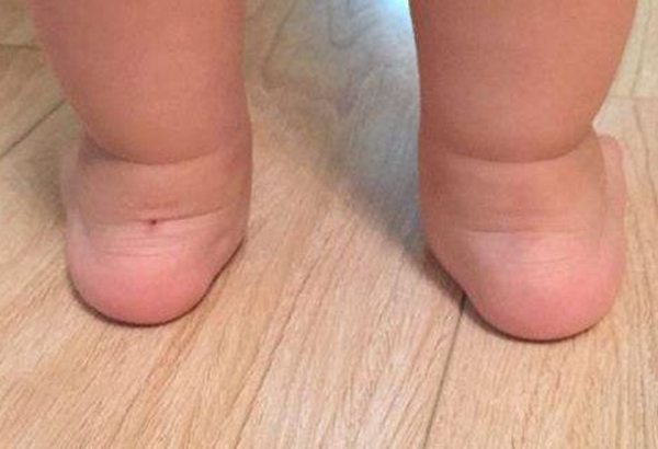 孩子脚跟疼是什么原因,孩子脚疼还肿怎么回事