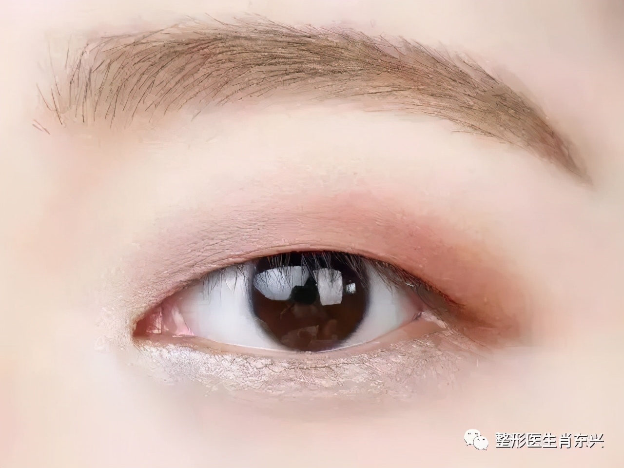 双眼皮埋线和割双眼皮有什么区别,除了割双眼皮怎么可以变成双眼皮