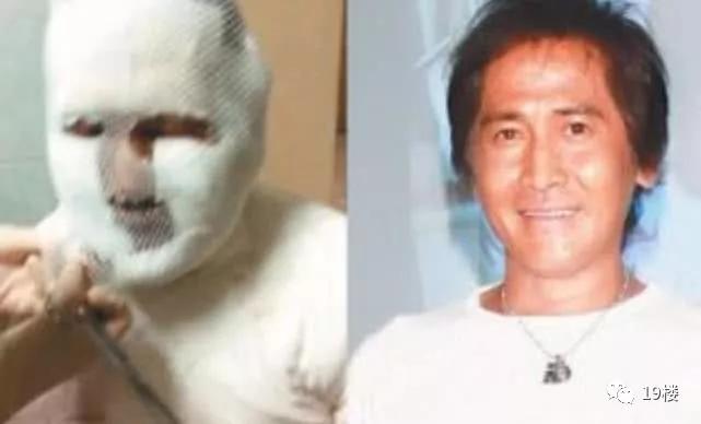 拔火罐烧伤的明星,明星拔火罐烧伤