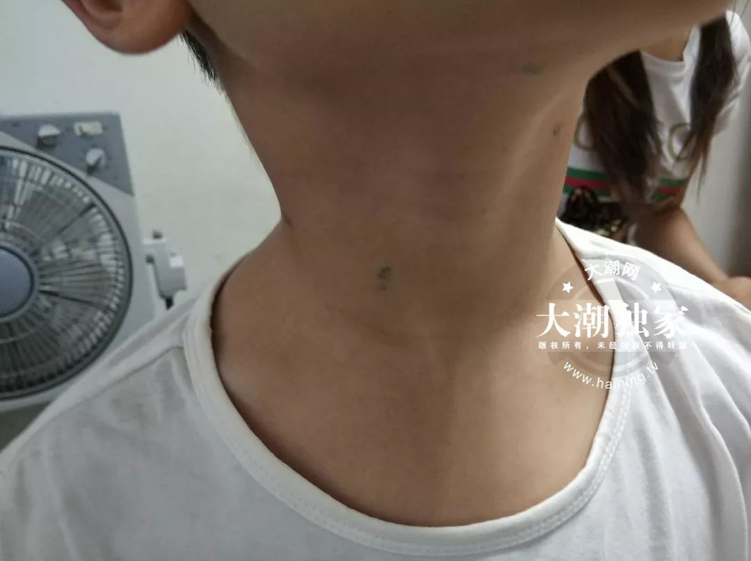 男童脖子上的针眼,10岁男孩颈部有密密麻麻红点