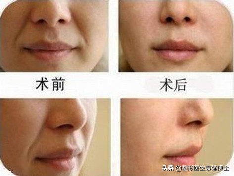 祛除法令纹最有效最自然的方法,淡化法令纹真正有效果的方法