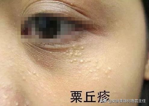 脂肪粒的形成原因及改善方法,脂肪粒形成的原因和消除方法