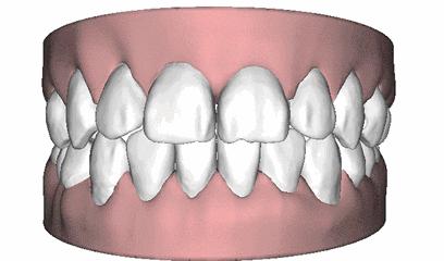 牙缝大怎么办五种方法帮助修复,怎样可以避免牙缝越来越大