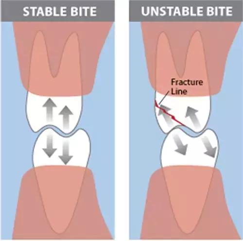 偏侧咀嚼造成脸歪补救,用一边牙齿咀嚼导致大小脸