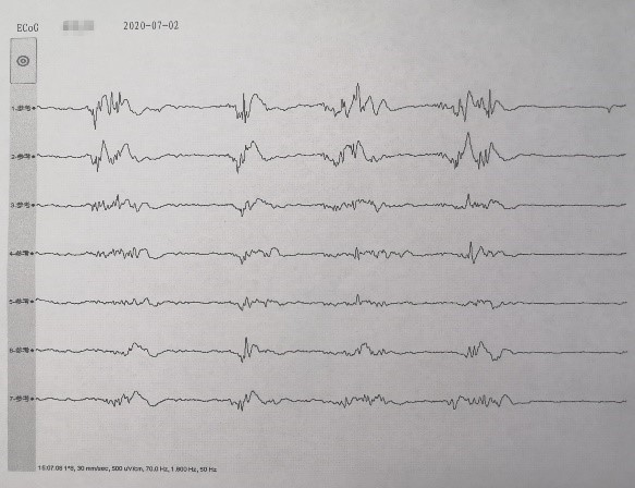 三叉神经痛需要抗癫痫治疗吗,癫痫引起的三叉神经痛怎么治疗