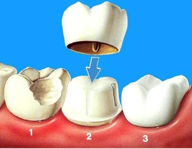 牙齿矫正和种植牙,牙齿矫正和烤瓷牙哪个更简单