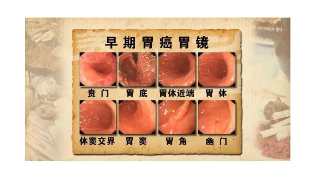 39岁女人胃癌晚期,40岁女人胃癌晚期症状