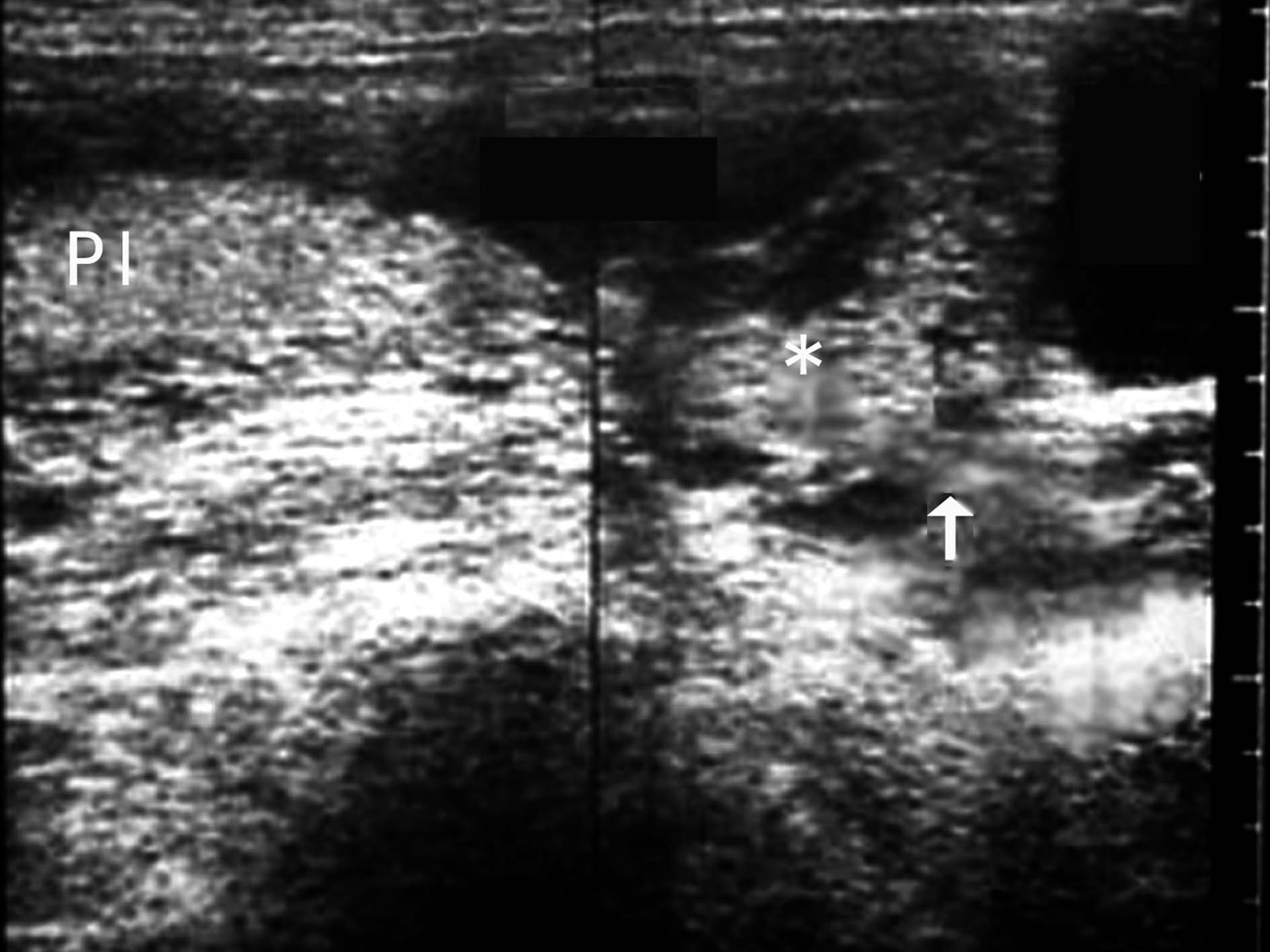 超声如何诊断前置胎盘,前置胎盘核磁报告显示胎盘无异常