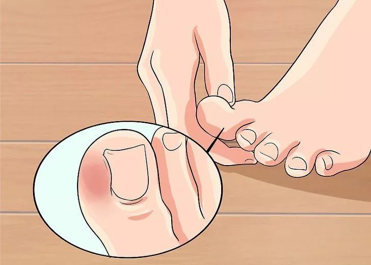 脚指甲两边向肉里扎,指甲小知识大全