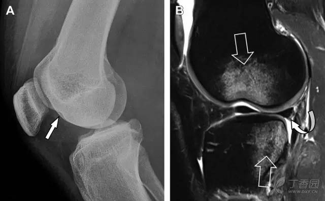 常见的八种骨折,容易漏诊的肩关节骨折