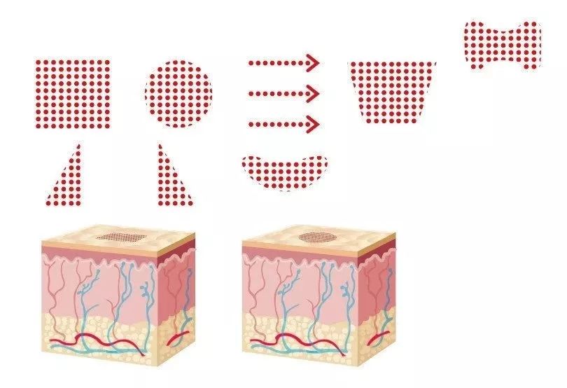 点阵激光祛陈旧疤痕有用吗,点阵激光治疗痘坑真的有用吗