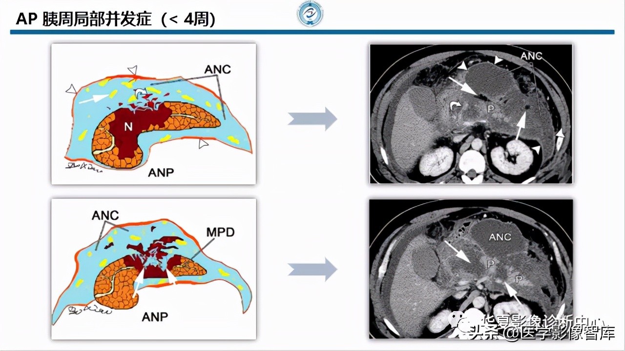 核磁ct都显示急性胰腺炎,急性坏死性胰腺炎的ct表现