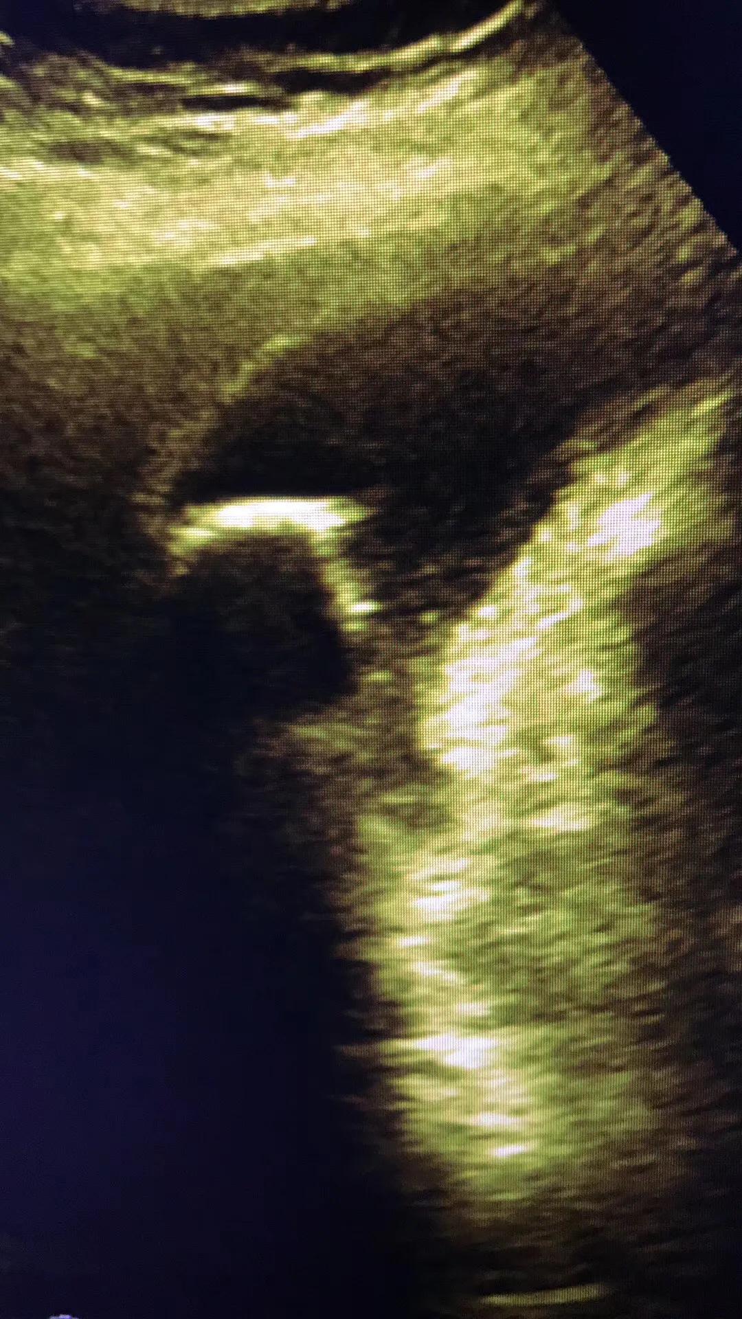 一公分胆结石并且引发急性胆囊炎,一颗胆结石必须摘胆吗