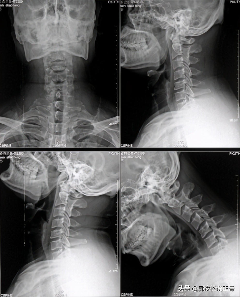 肩颈痛导致头痛怎么治疗,颈源性头痛病例