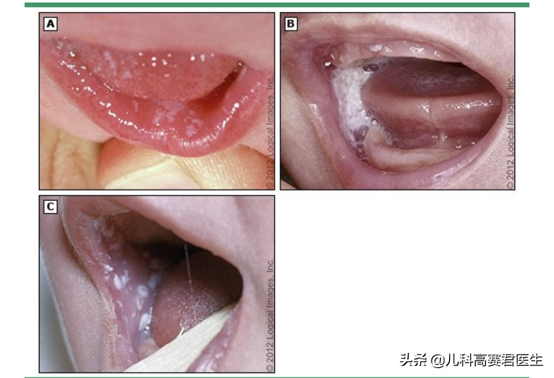 宝宝鹅口疮怎么治,宝宝鹅口疮怎么办最快最有效