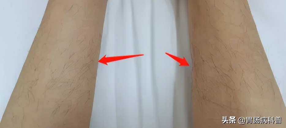 70岁老太，长出粗黑腿毛，医生说，这可能是癌的征兆