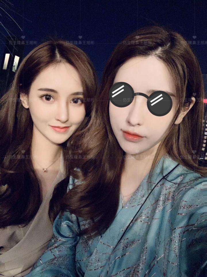 线雕隆鼻后鼻综合修复术,隆鼻失败修复手术真实案例