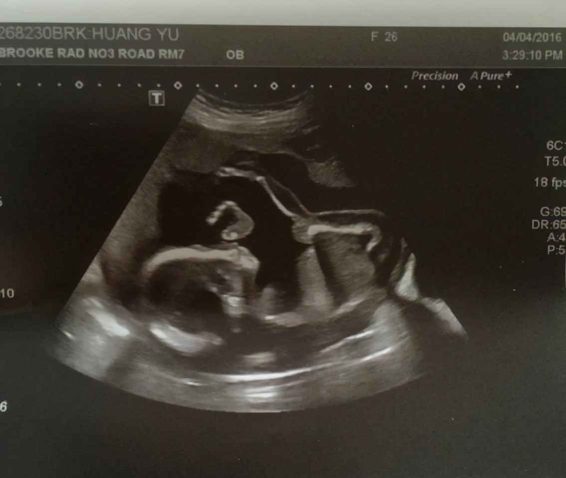 孕期征兆暗示你怀孕,孕期反应大说明胎儿调皮吗