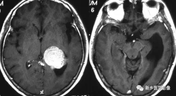 脑室为什么会扩张,脑室为什么会变小