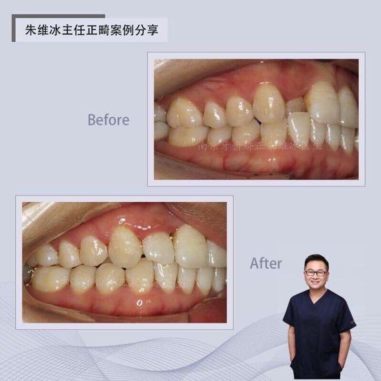 南京正畸朱维冰怎么样,南京牙齿正畸矫正技术