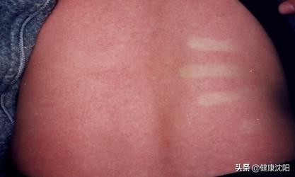 猩红热十大忌口,健康科普带您了解流行性出血热